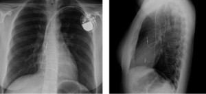 Chest X-ray