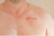 Pacemaker Surgery