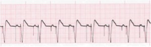 pacemaker activity