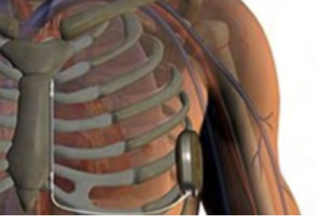 Subcutaneous ICD