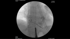 Fluoroscopic image
