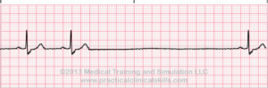 Rhythm strip showing a pause in the heart rhythm.